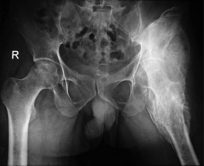 X-ray of patient showing extensive heterotopic ossification around left hip with ankylosis of left hip